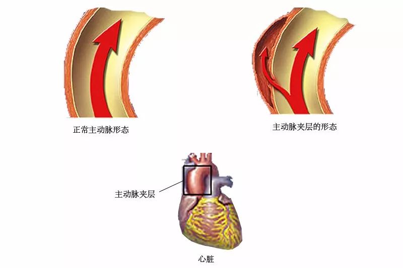 所以,主动脉夹层被称为一颗随时会引爆的不定时炸弹.